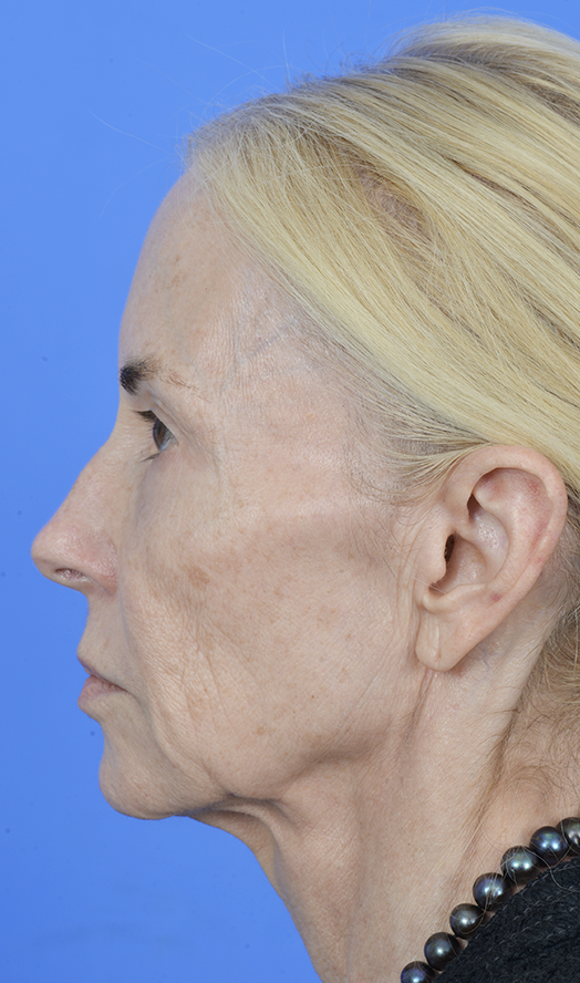 Patient Before & After Photo