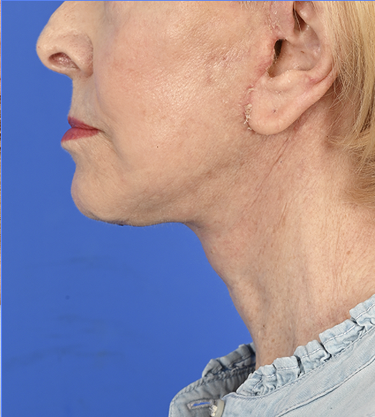 Case--9885 | After Face & Neck