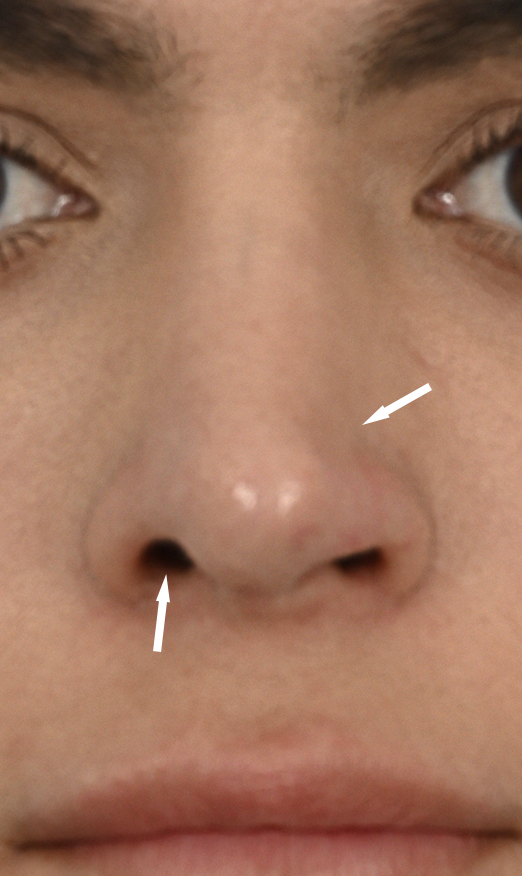 Case--5625 | Before Revision Rhinoplasty