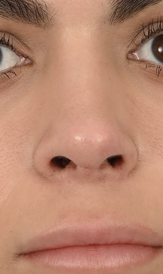 Case--5625 | After Revision Rhinoplasty