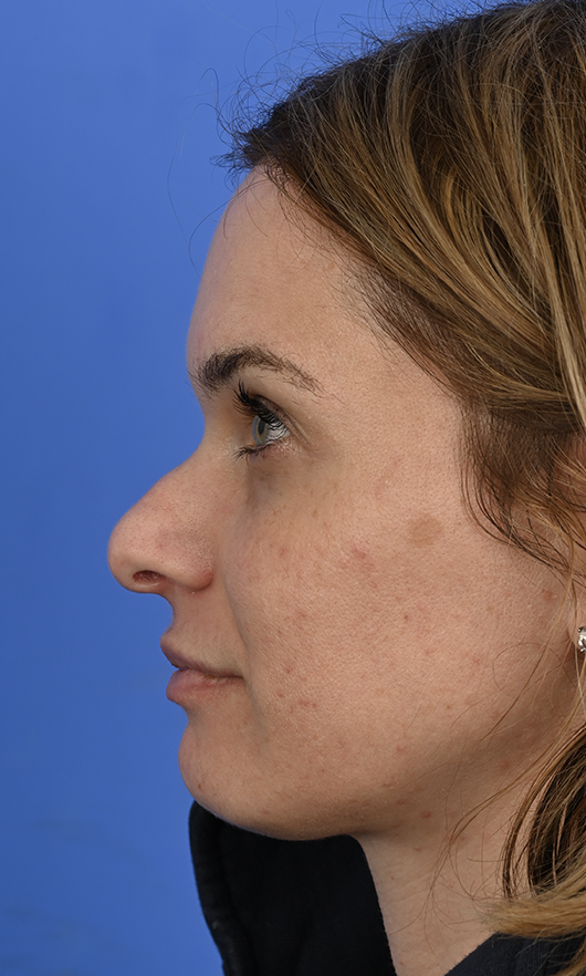Case--9088 | Before Revision Rhinoplasty