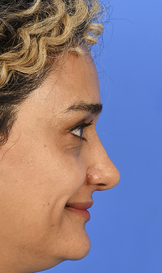 Case--1609 | After Rhinoplasty