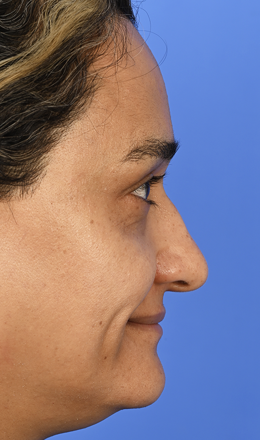 Case--1609 | Before Rhinoplasty