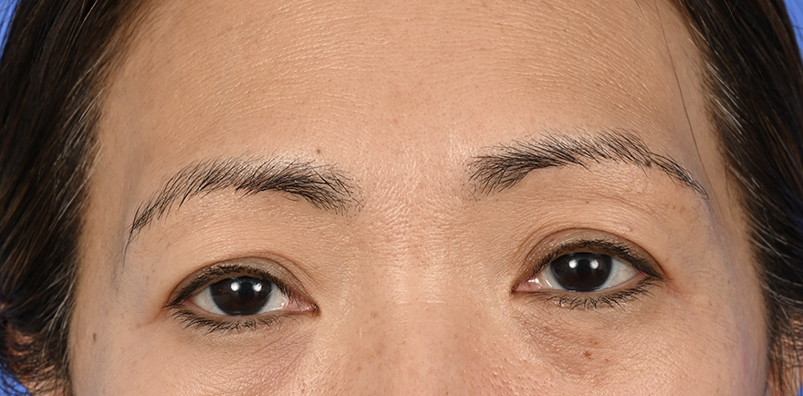 Case--1754 | Before Brow Lift