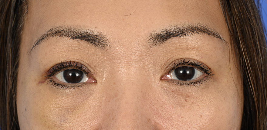 Case--1754 | After Brow Lift