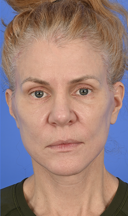 Case--6227 | After Brow Lift