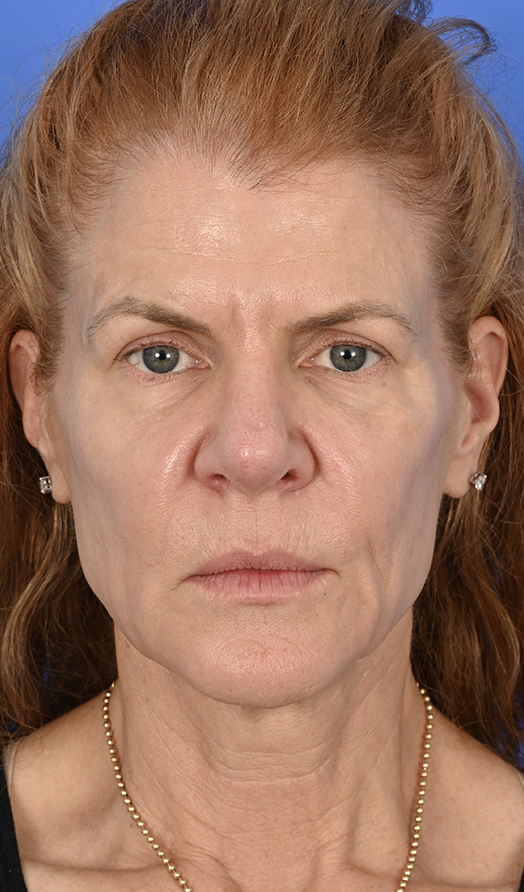 Case--6227 | Before Brow Lift