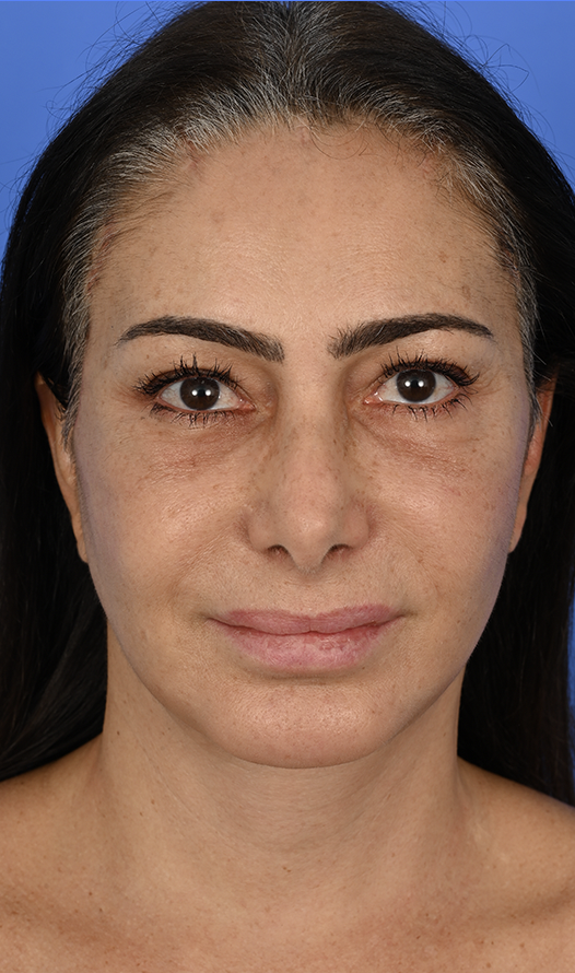 Case--1402 | After Brow Lift