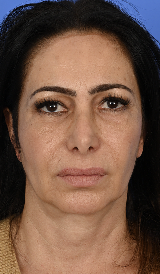 Case--1402 | Before Brow Lift