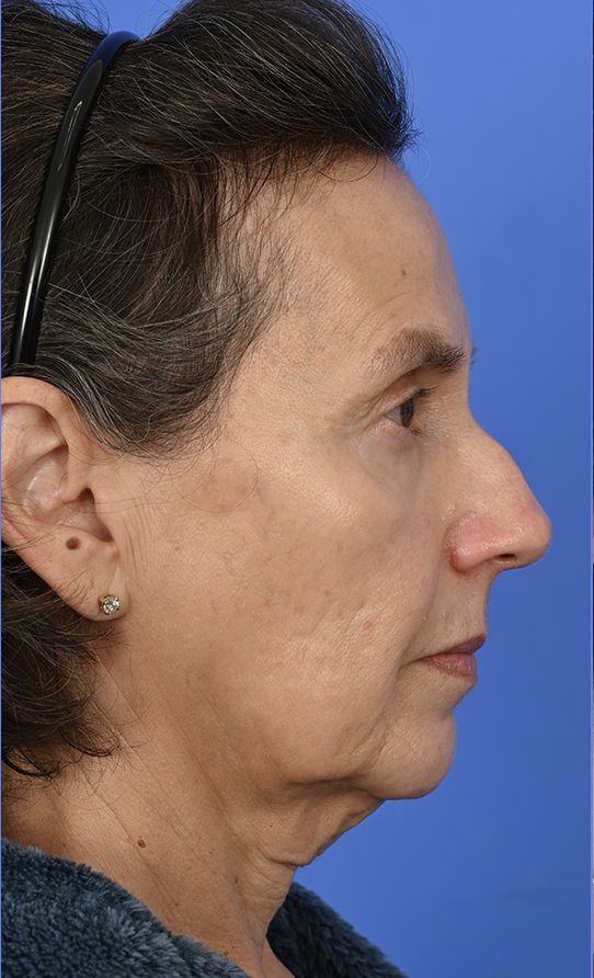 Patient Before & After Photo