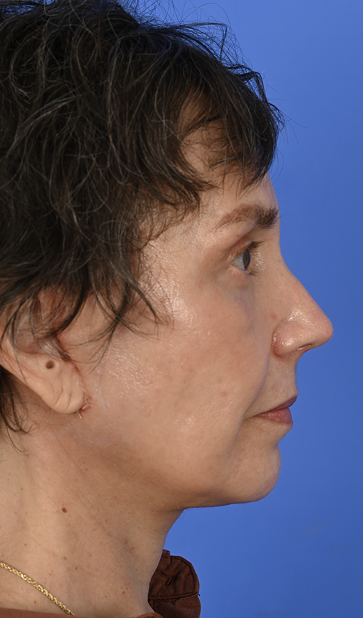 Patient Before & After Photo
