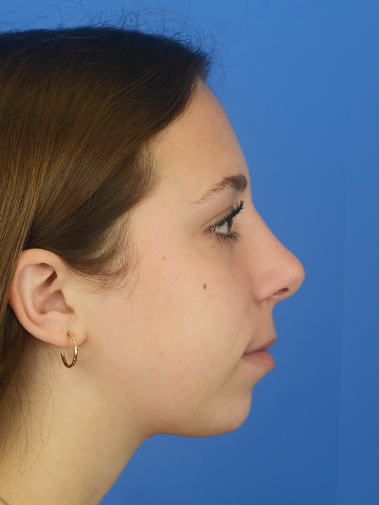 Teenage-Rhinoplasty-to-reduce-hump-and-elevate-tip-in-Houston--TX | After Buccal Fat Removal
