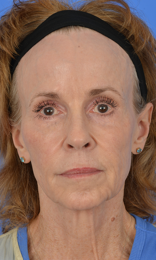 Case--9699 | Before Brow Lift