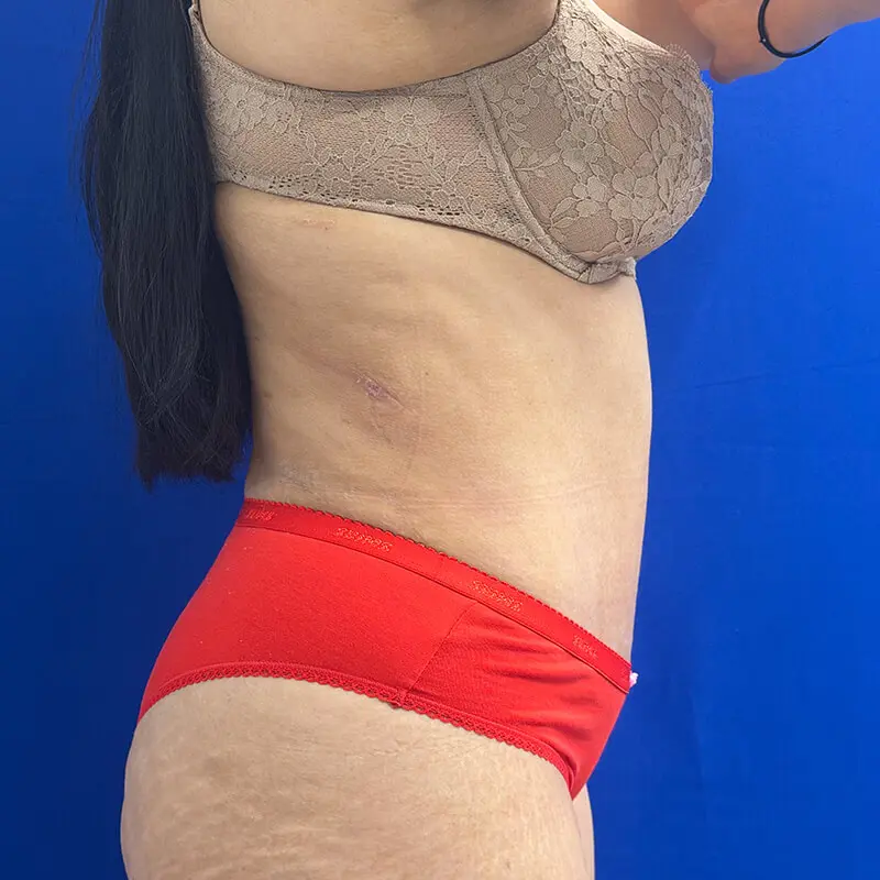 Patient Before & After Photo