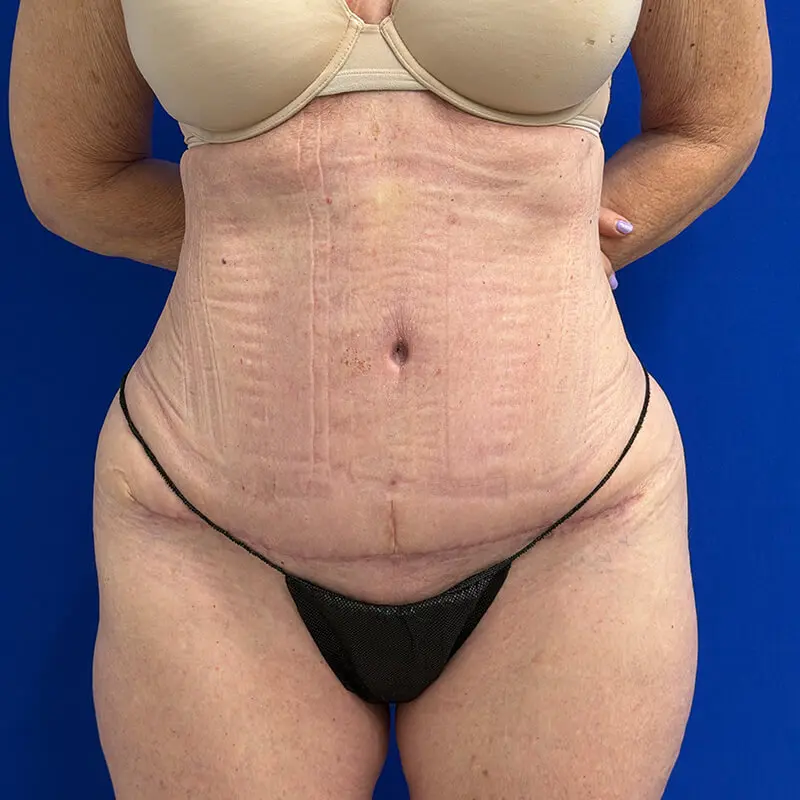 Case--1787 | After Tummy Tuck