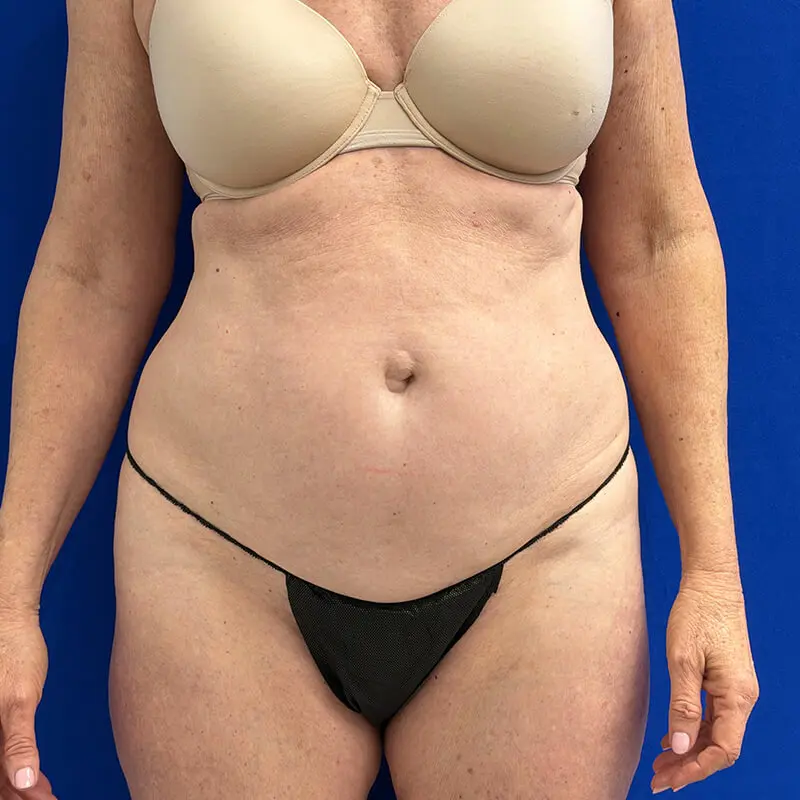 Case--1787 | Before Tummy Tuck