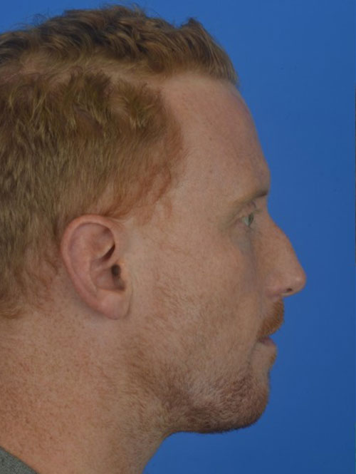 Patient Before & After Photo