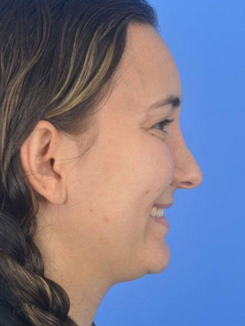 Patient Before & After Photo