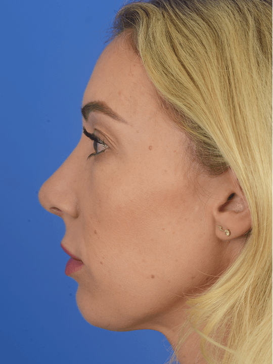 Amazing-Results--Houston--TX-Rhinoplasty | After Ethnic Rhinoplasty