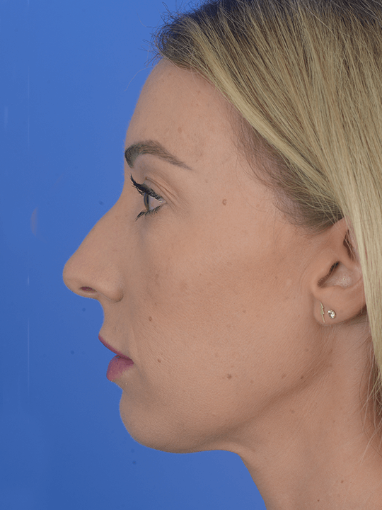 Amazing-Results--Houston--TX-Rhinoplasty | Before Ethnic Rhinoplasty