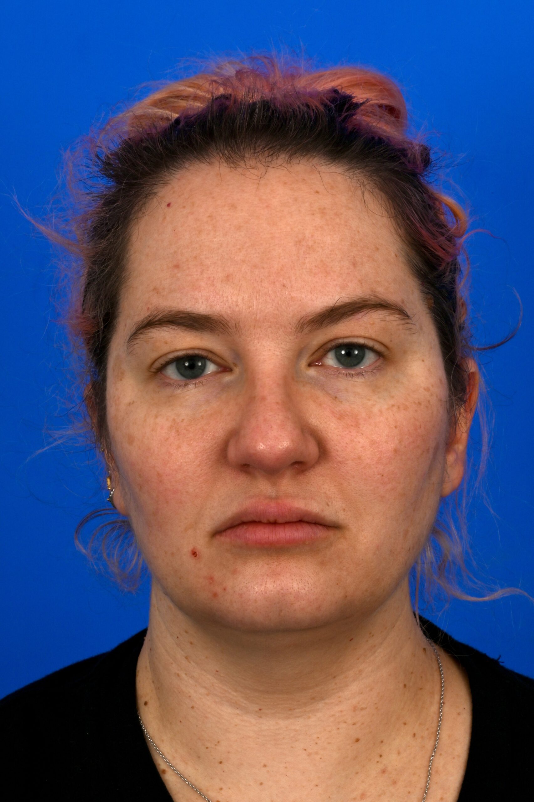 Case--7294 | Before Face & Neck