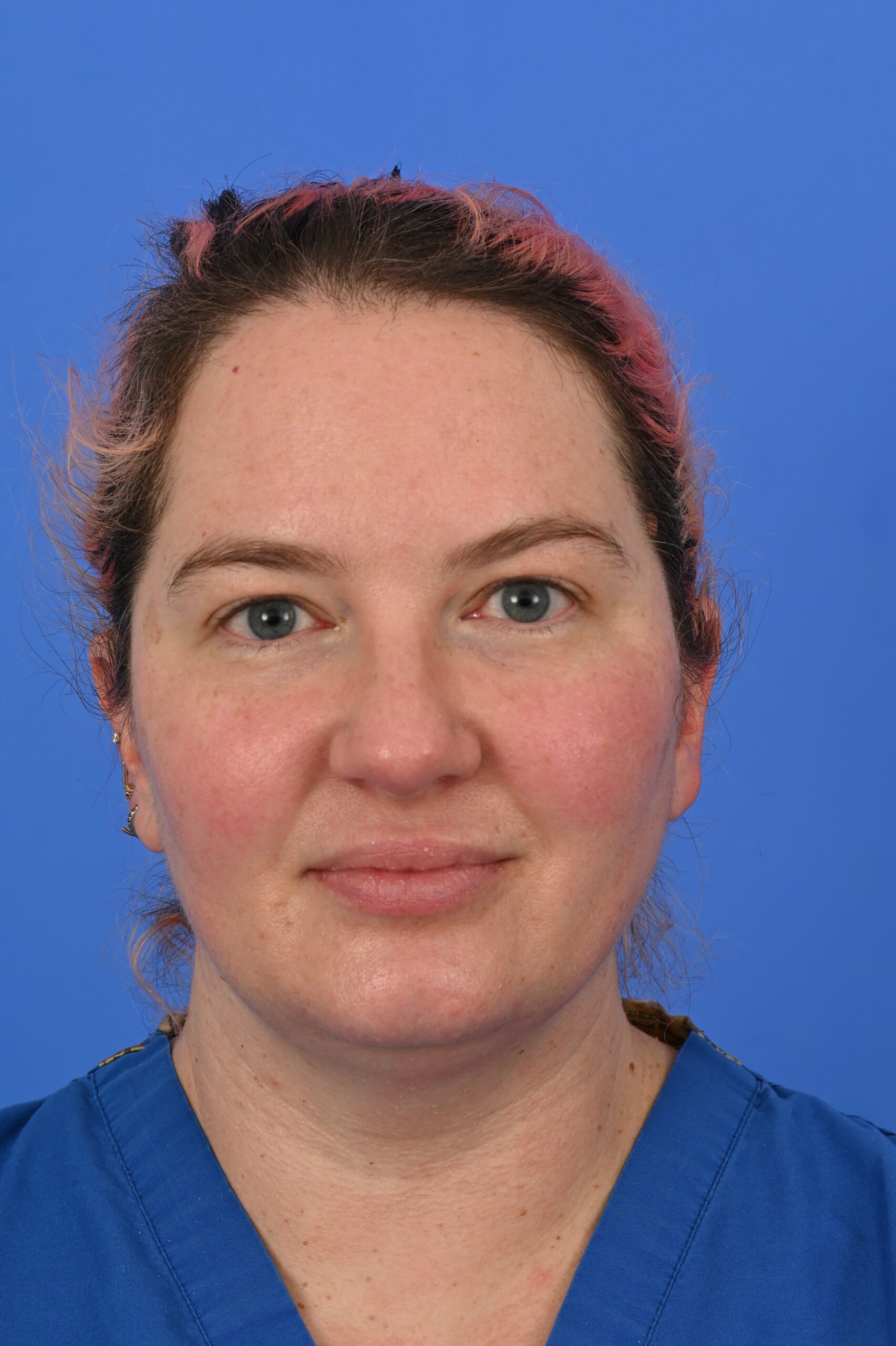 Case--7294 | After Face & Neck