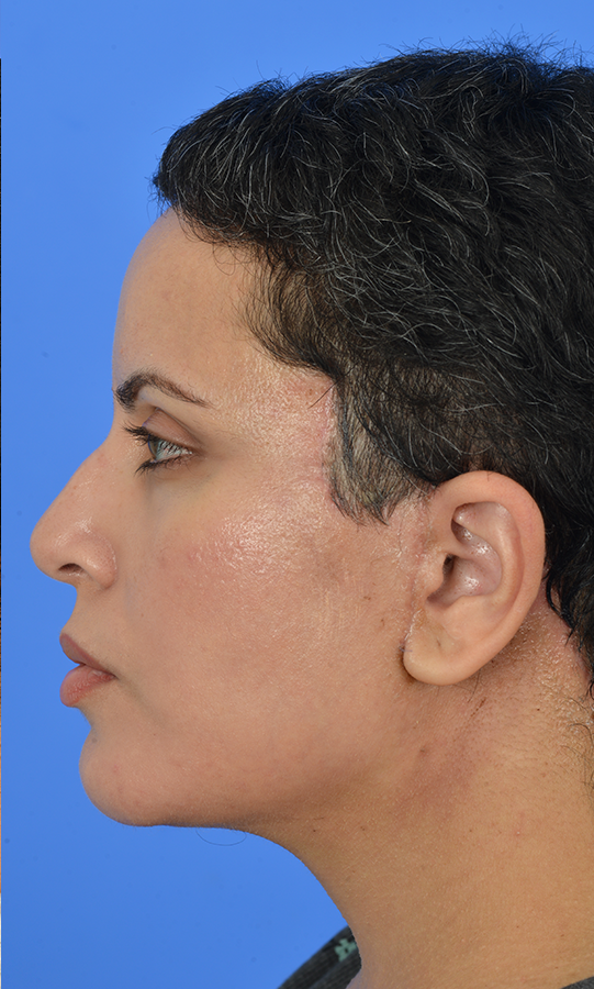 Patient Before & After Photo