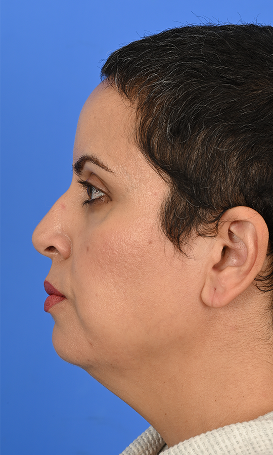 Patient Before & After Photo