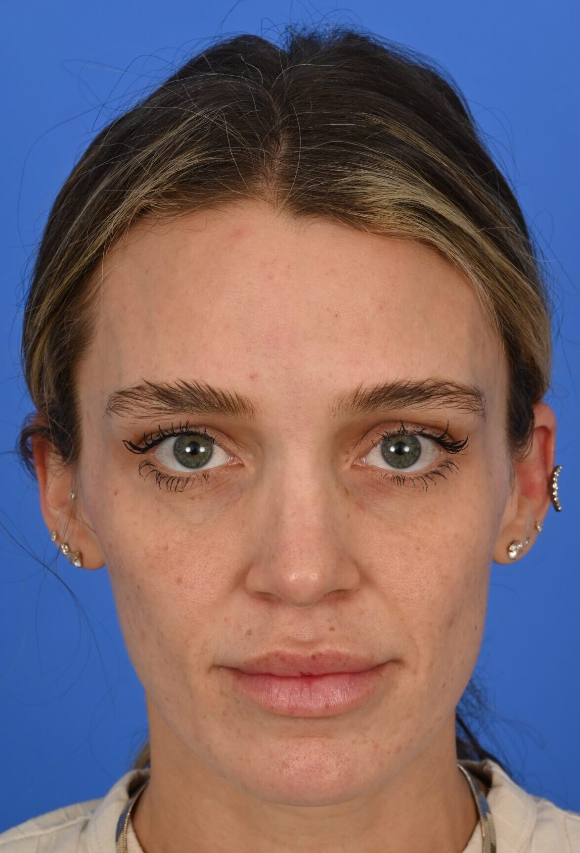 Case--4181 | Before FaceTite™