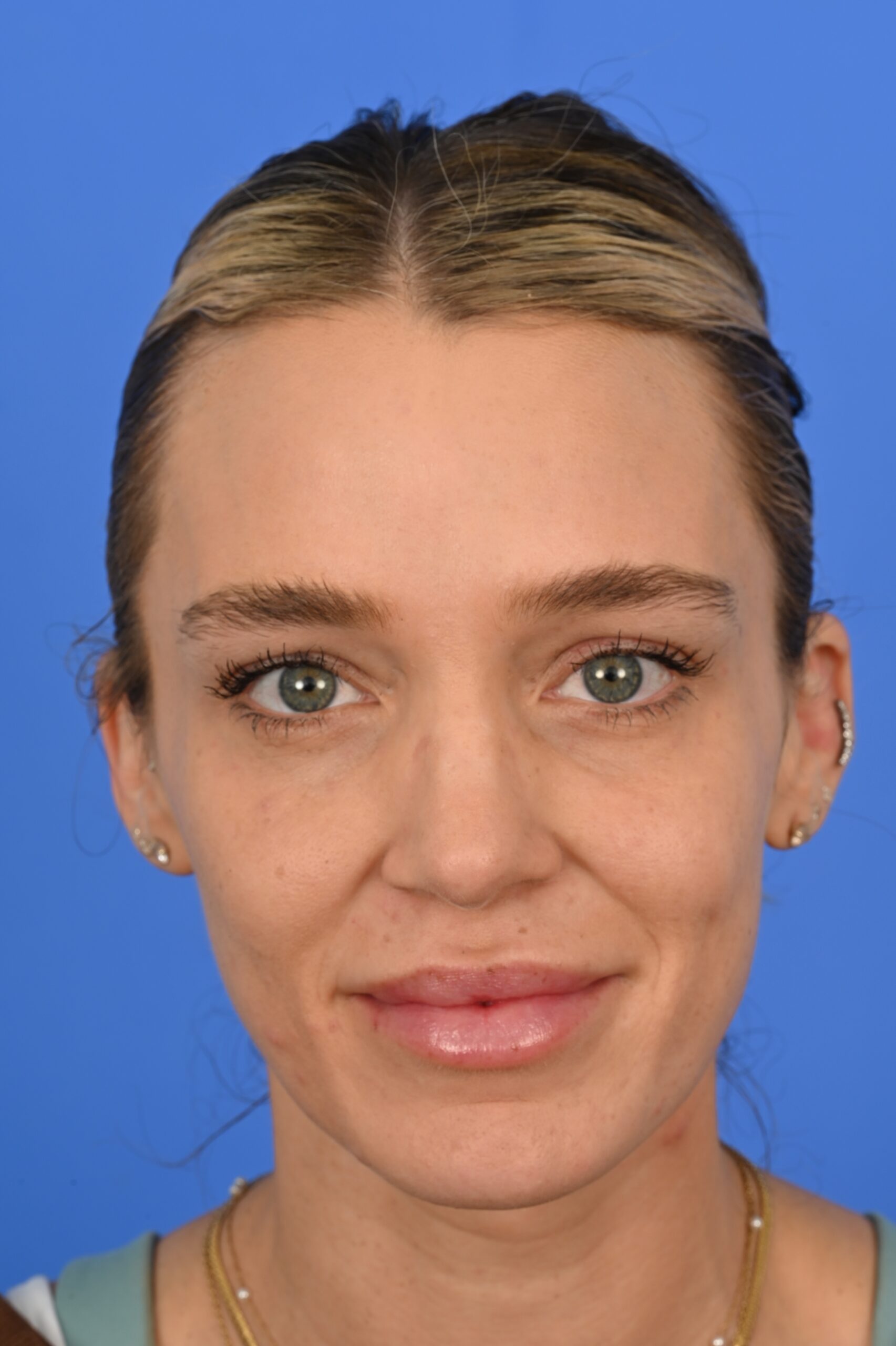 Case--4181 | After FaceTite™